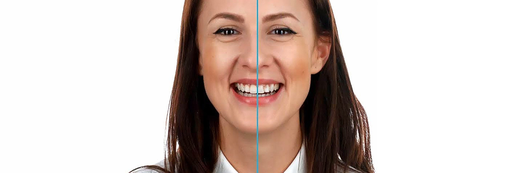 Warum-Lingual-kontrollierte-Zahnbewegung
